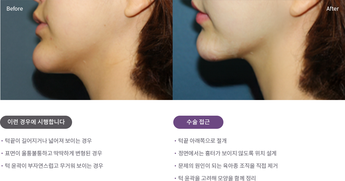 턱끝 육아종 절제술 예